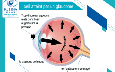 GLAUCOME CHRONIQUE A ANGLE OUVERT