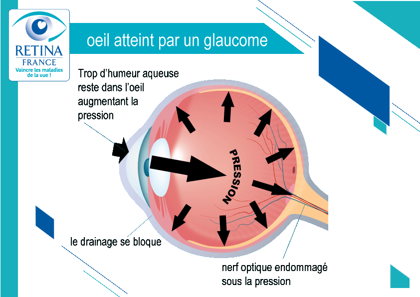 GLAUCOME CHRONIQUE A ANGLE OUVERT