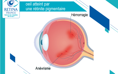 Amaurose congénitale de Leber