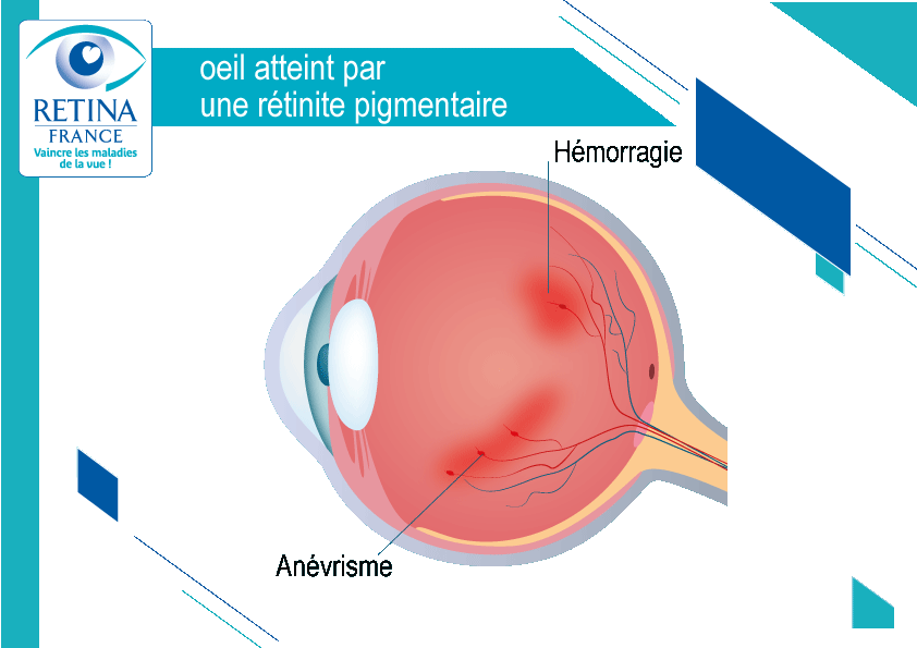 Amaurose congénitale de Leber