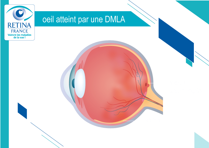 Schéma oeil DMLA