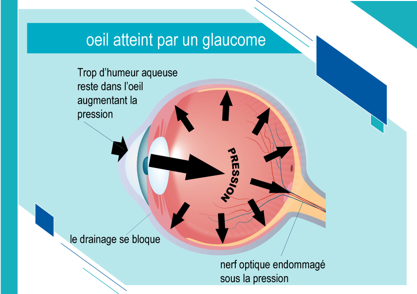 schema glaucome