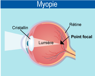 schema-myopie