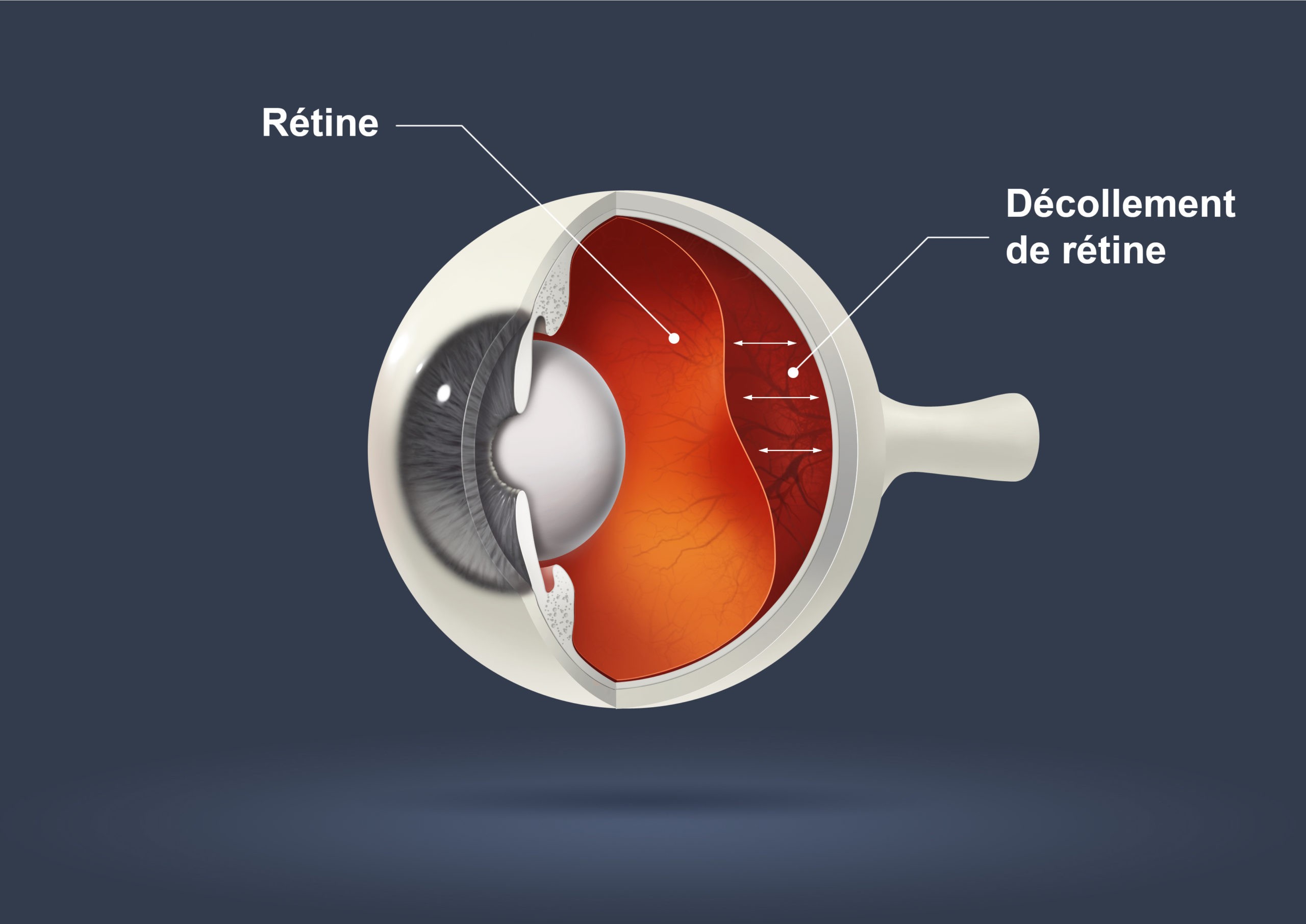 schéma-decollement-retine