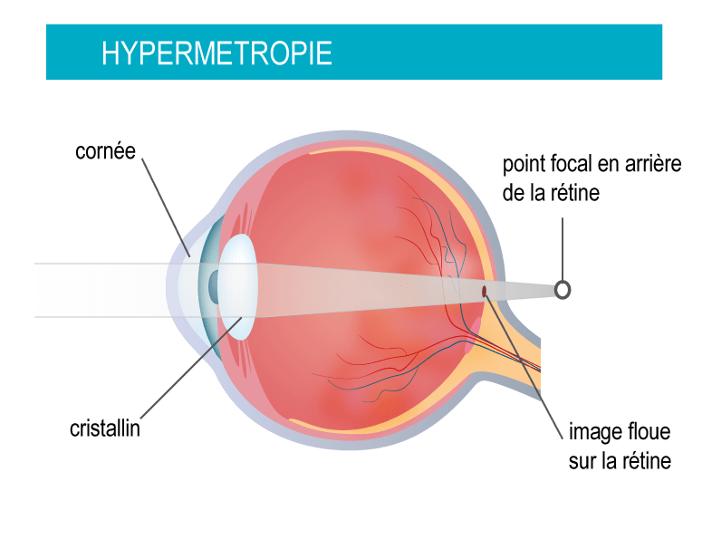 hypermetropie