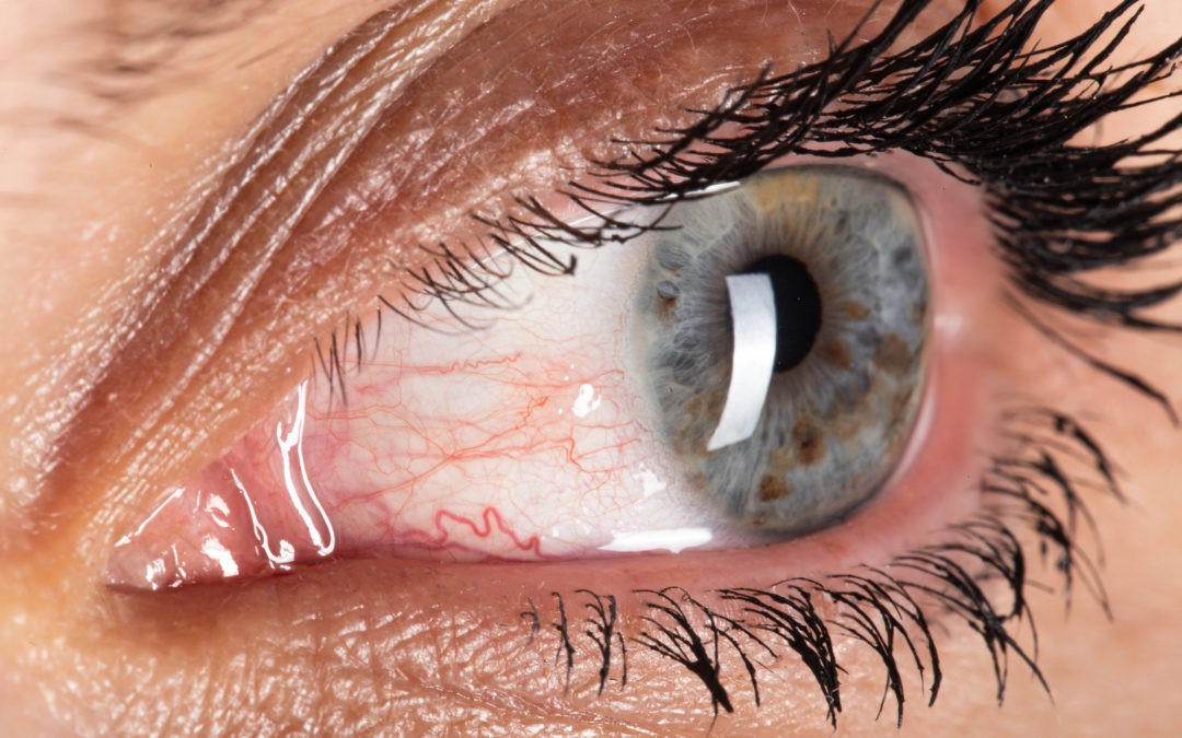 Occlusion veineuse rétinienne : un “AVC de l’œil” à surveiller de près