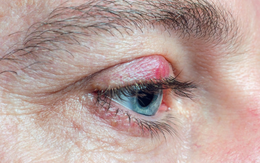 Le chalazion : comprendre et traiter cette affection oculaire
