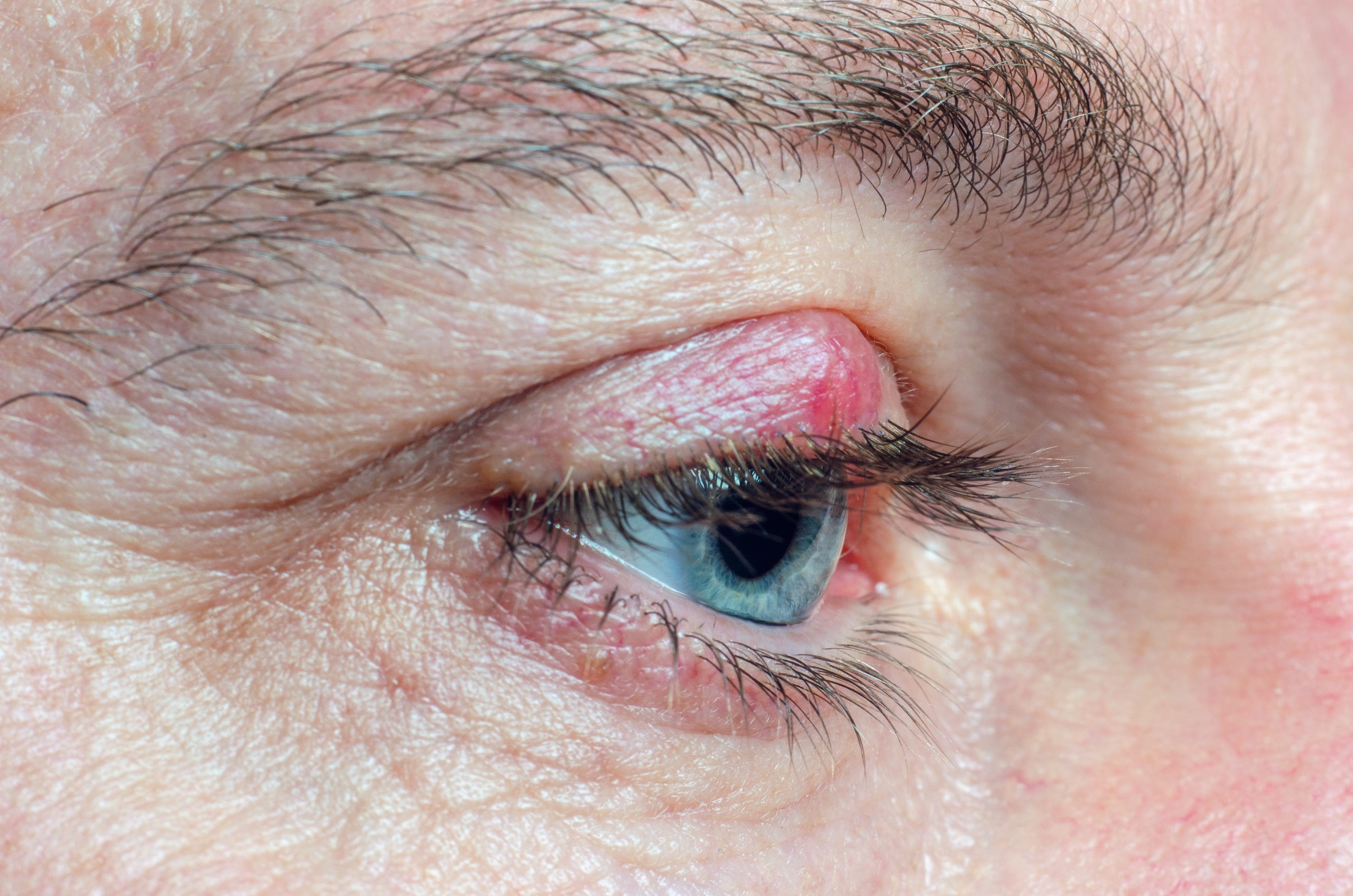 chalazion